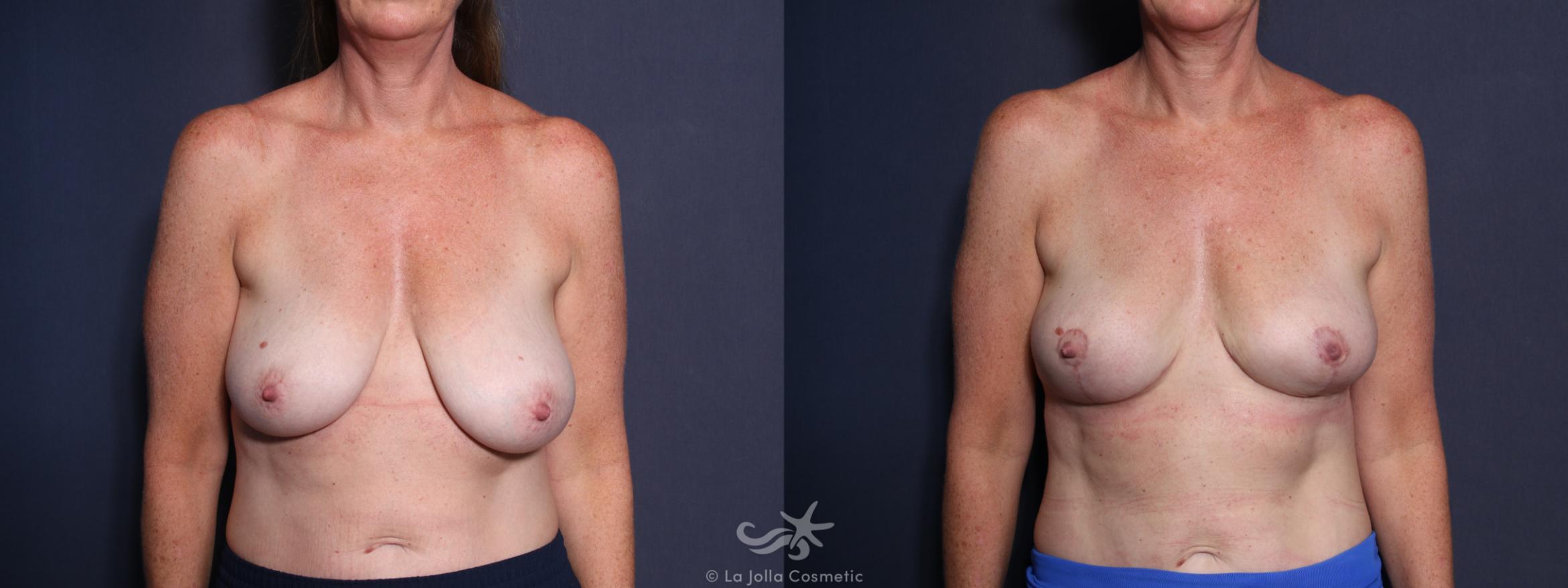 Before & After Breast Lift Result 80 Front View in San Diego, CA