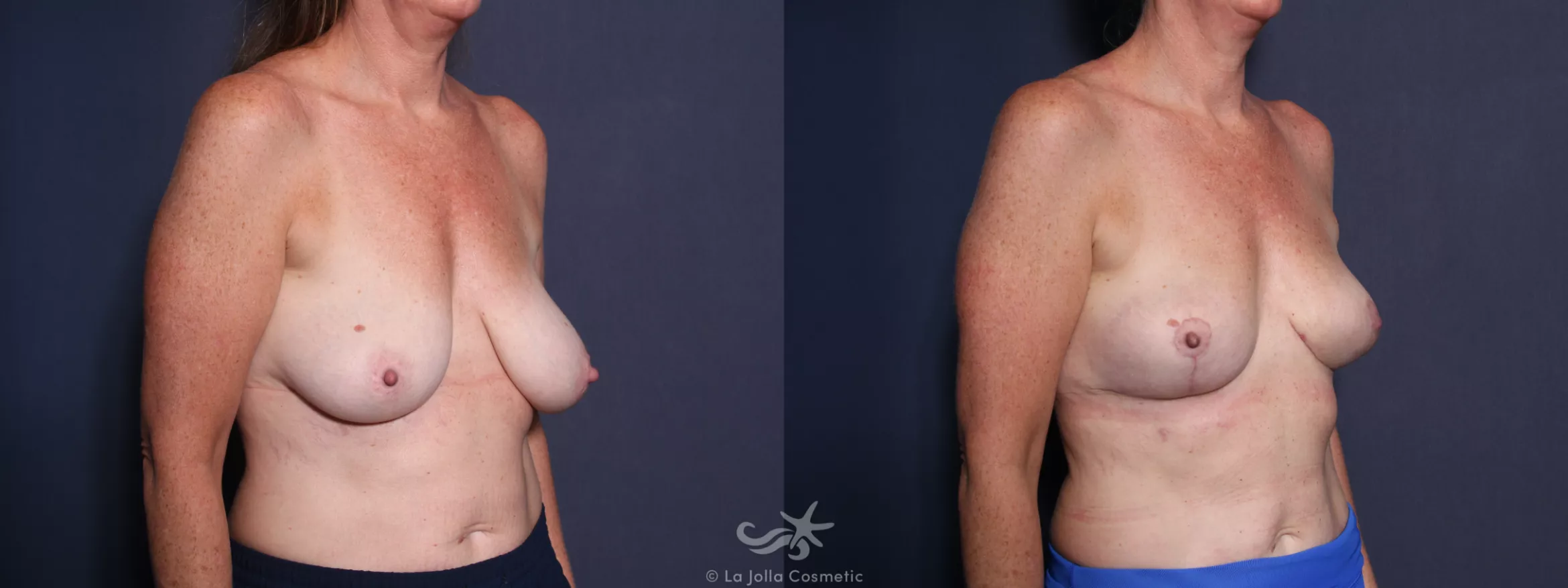 Before & After Breast Lift Result 80 Right Oblique View in San Diego, CA