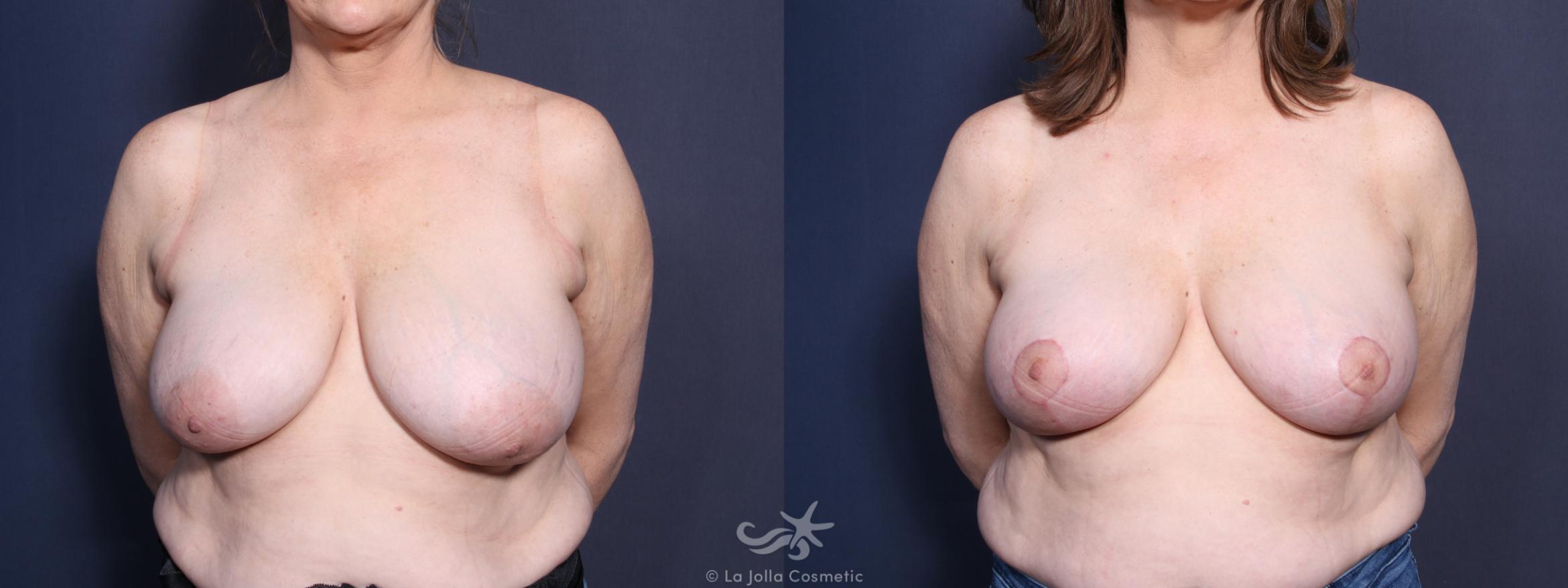 Before & After Breast Reduction Result 85 Front View in San Diego, CA