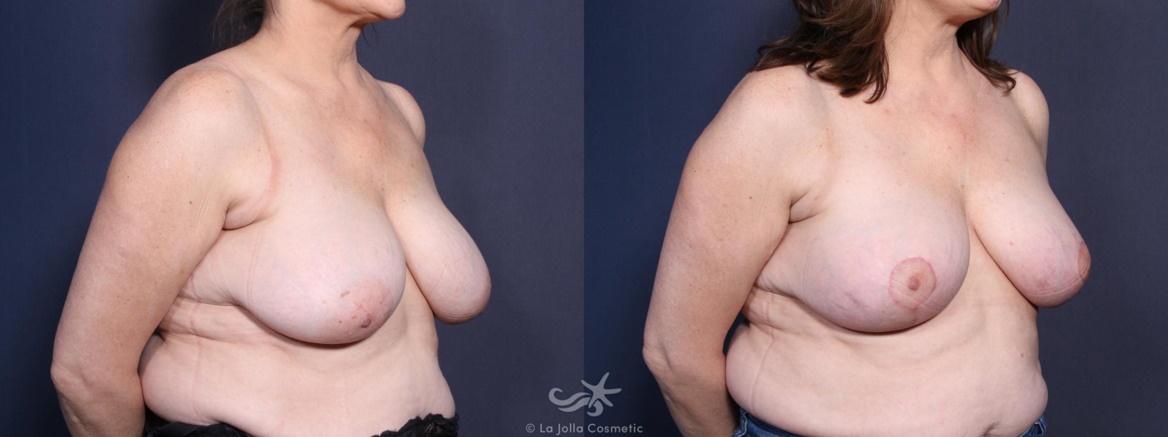 Before & After Breast Reduction Result 85 Right Oblique View in San Diego, CA
