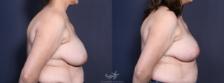Before & After Breast Lift Result 85 Right Side View in San Diego, Carlsbad, CA