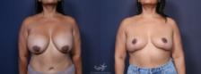 Before & After Breast Lift Result 91 Front View in San Diego, Carlsbad, CA