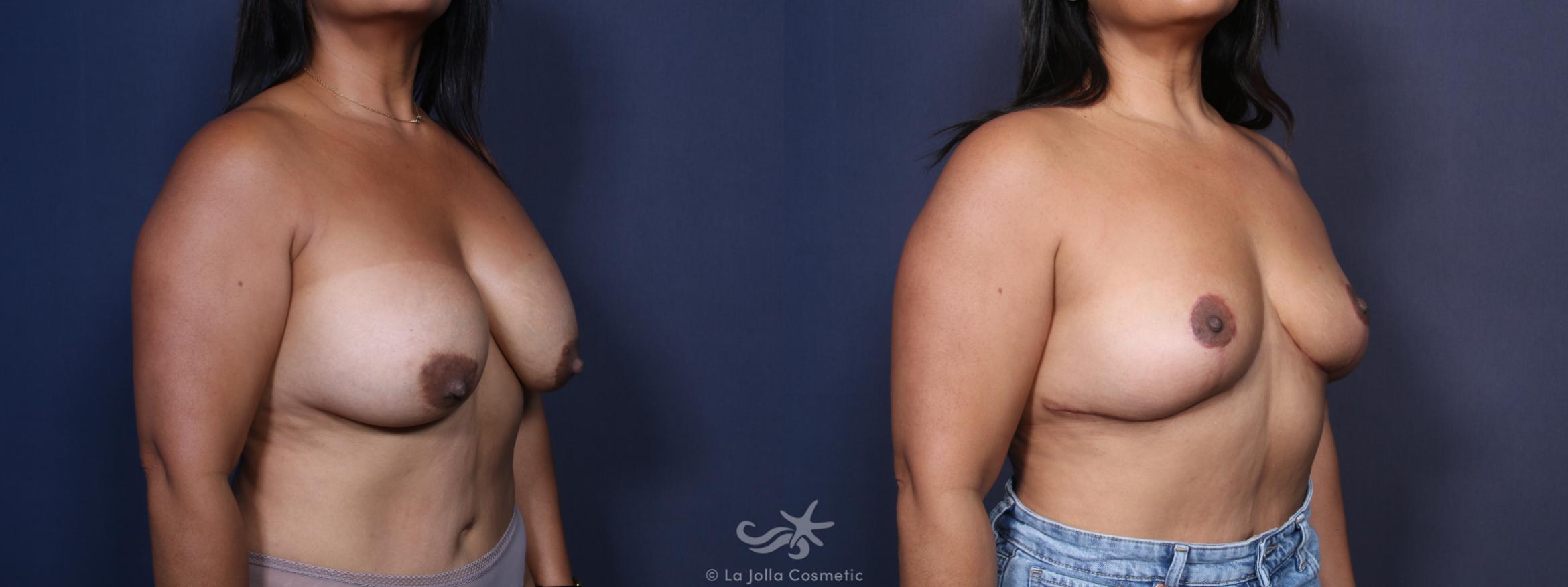 Before & After Breast Implant Removal Result 91 Right Oblique View in San Diego, CA