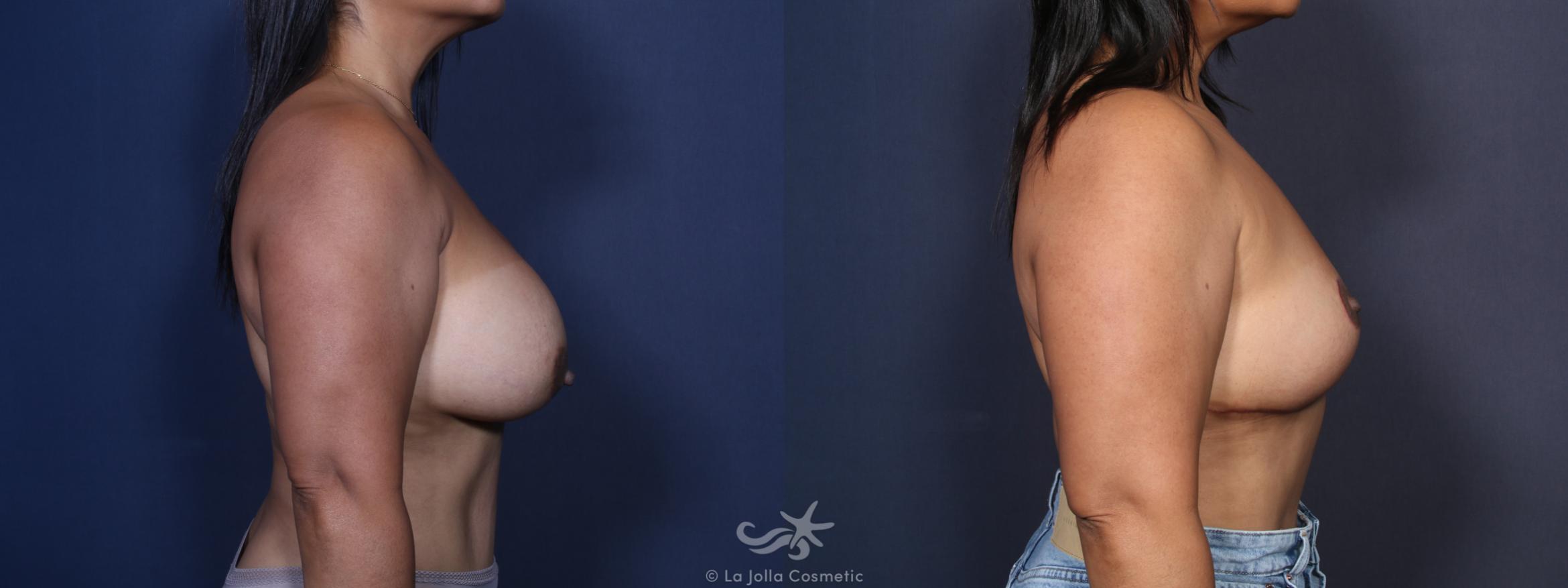 Before & After Breast Implant Removal Result 91 Right Side View in San Diego, CA