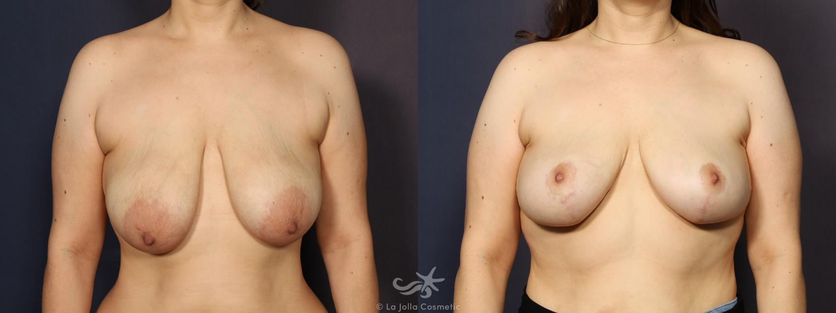 Before & After Breast Reduction Result 1062 Front View in San Diego, CA