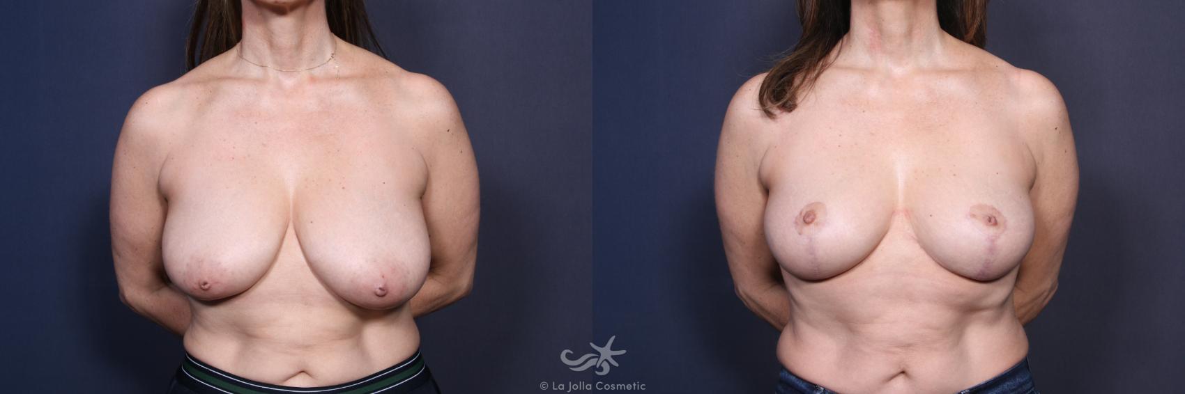 Before & After Breast Reduction Result 122 Front View in San Diego, CA
