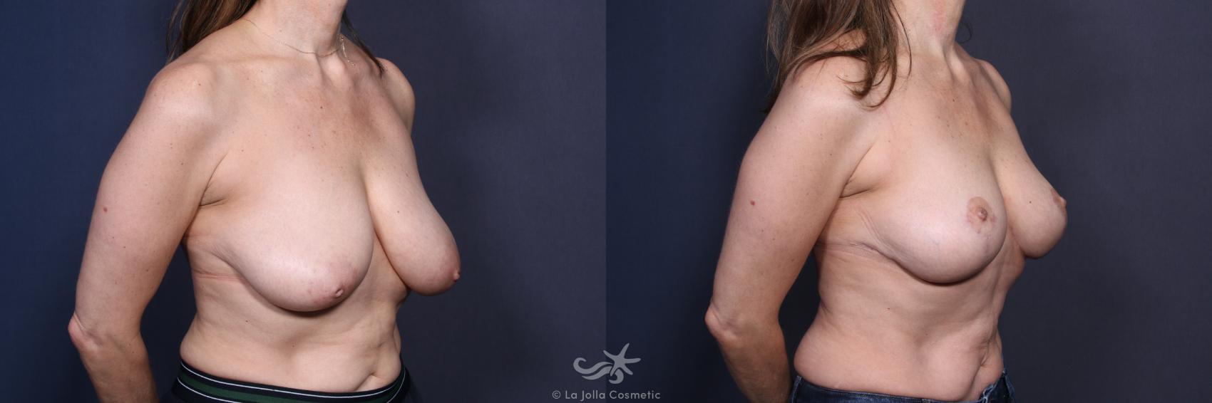Before & After Breast Reduction Result 122 Right Oblique View in San Diego, CA