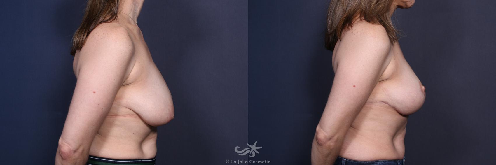 Before & After Breast Reduction Result 122 Right Side View in San Diego, CA