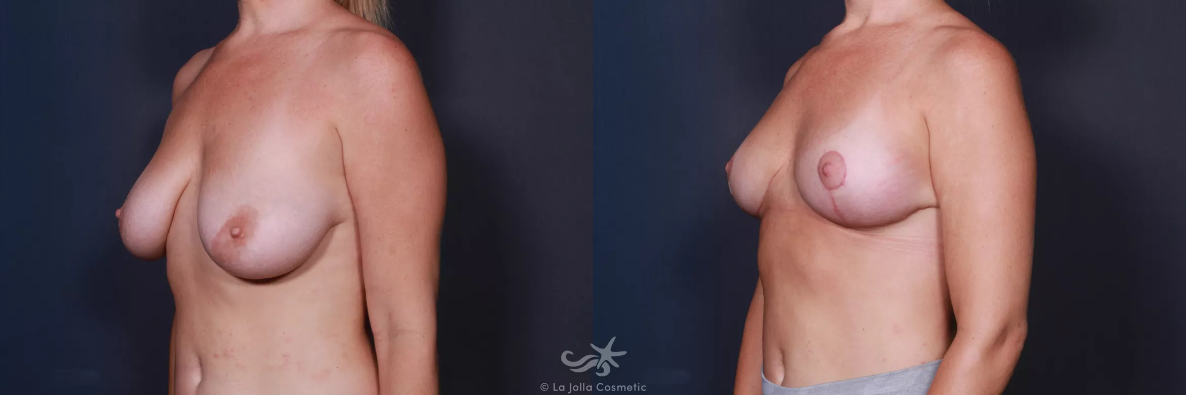 Before & After Breast Reduction Result 186 Left Oblique View in San Diego, CA