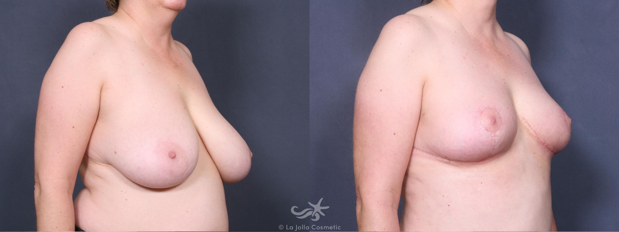Before & After Breast Reduction Result 267 Right Oblique View in San Diego, CA