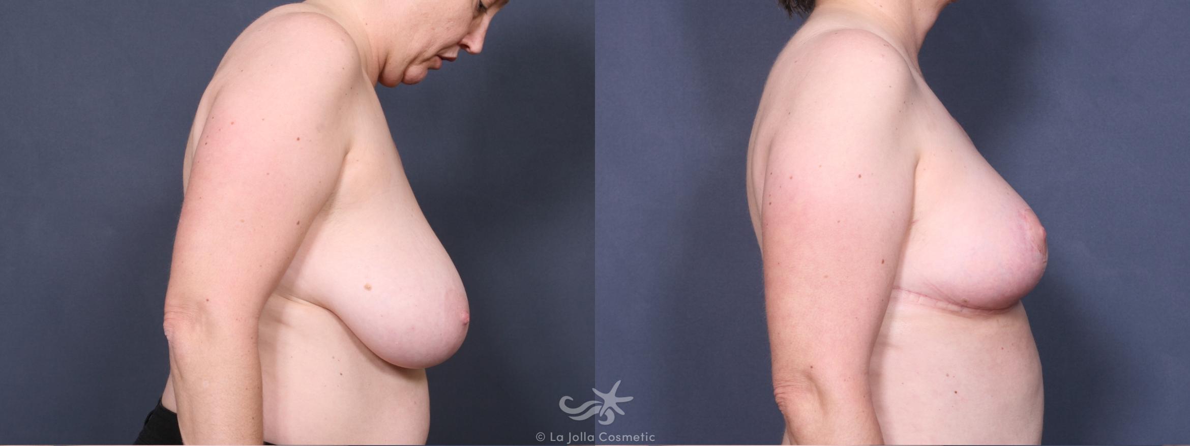 Before & After Breast Reduction Result 267 Right Side View in San Diego, CA
