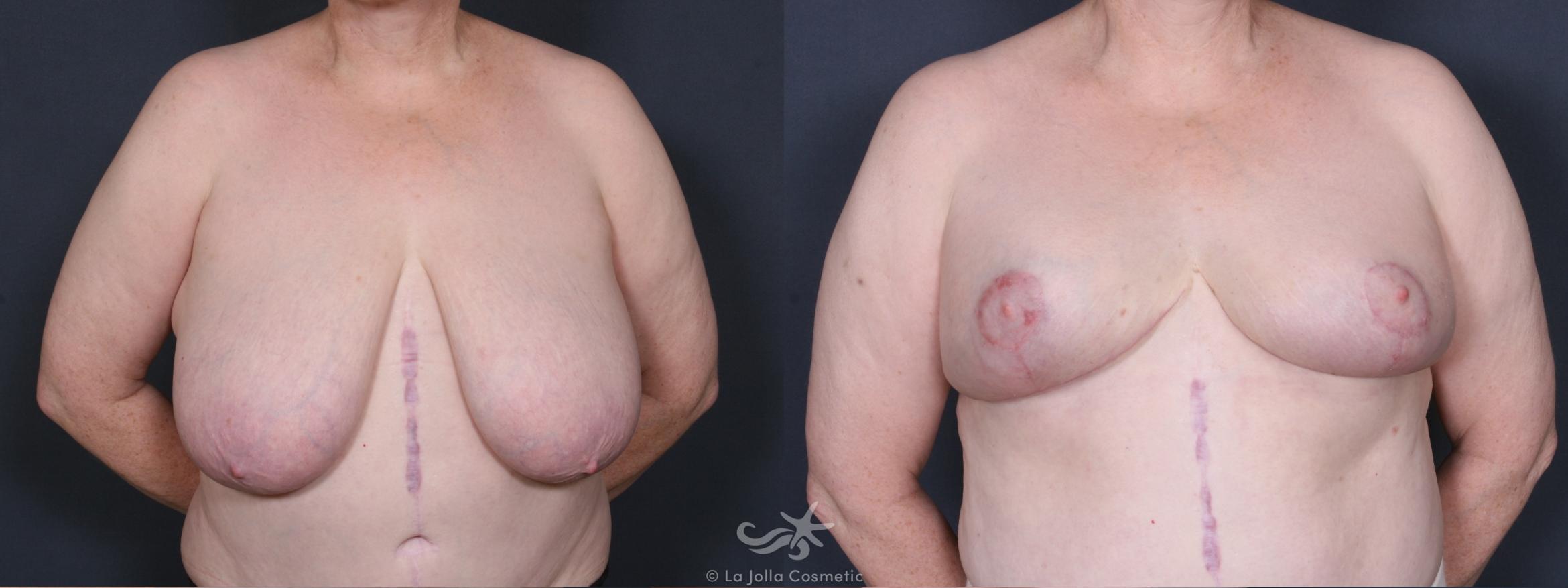 Before & After Breast Reduction Result 413 Front View in San Diego, CA