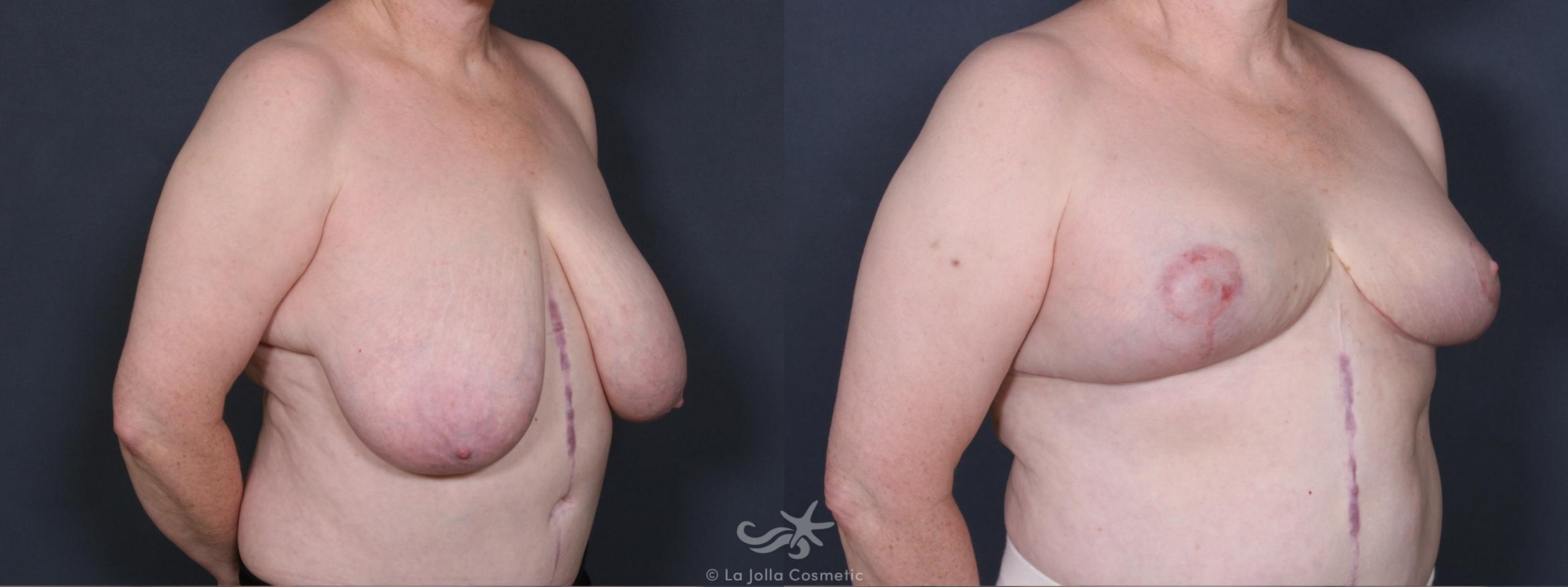 Before & After Breast Reduction Result 413 Right Oblique View in San Diego, CA