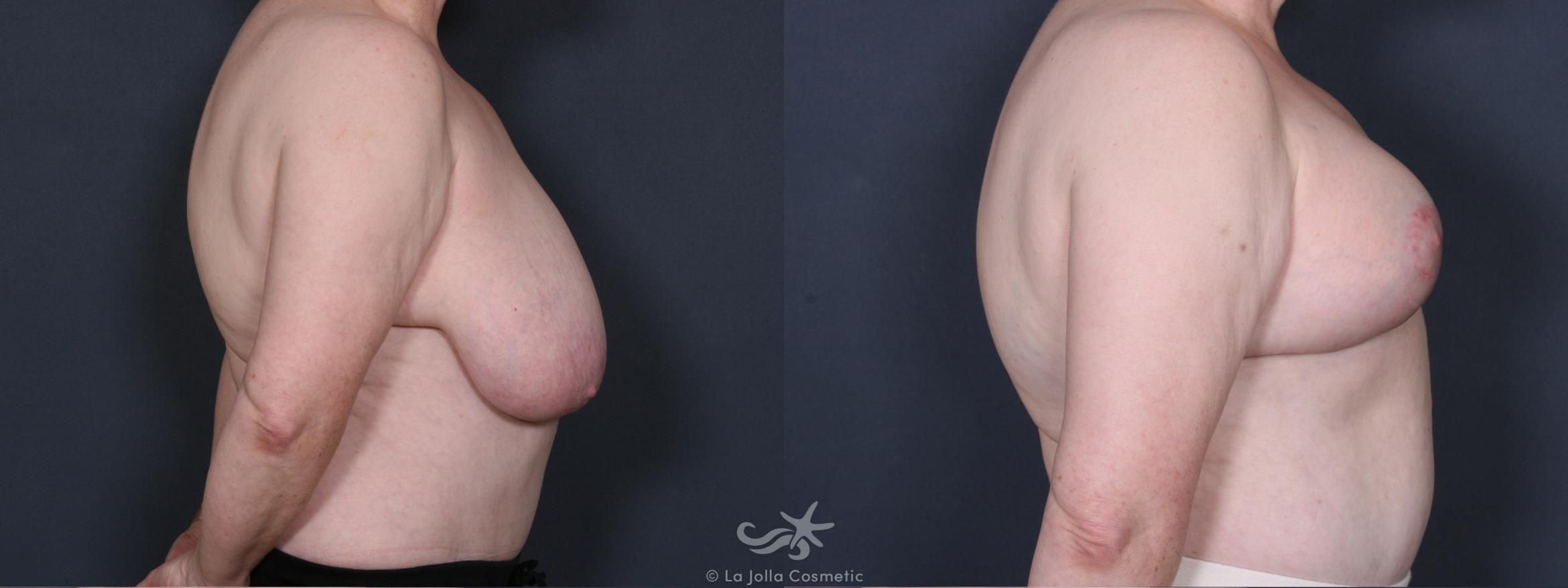 Before & After Breast Reduction Result 413 Right Side View in San Diego, CA