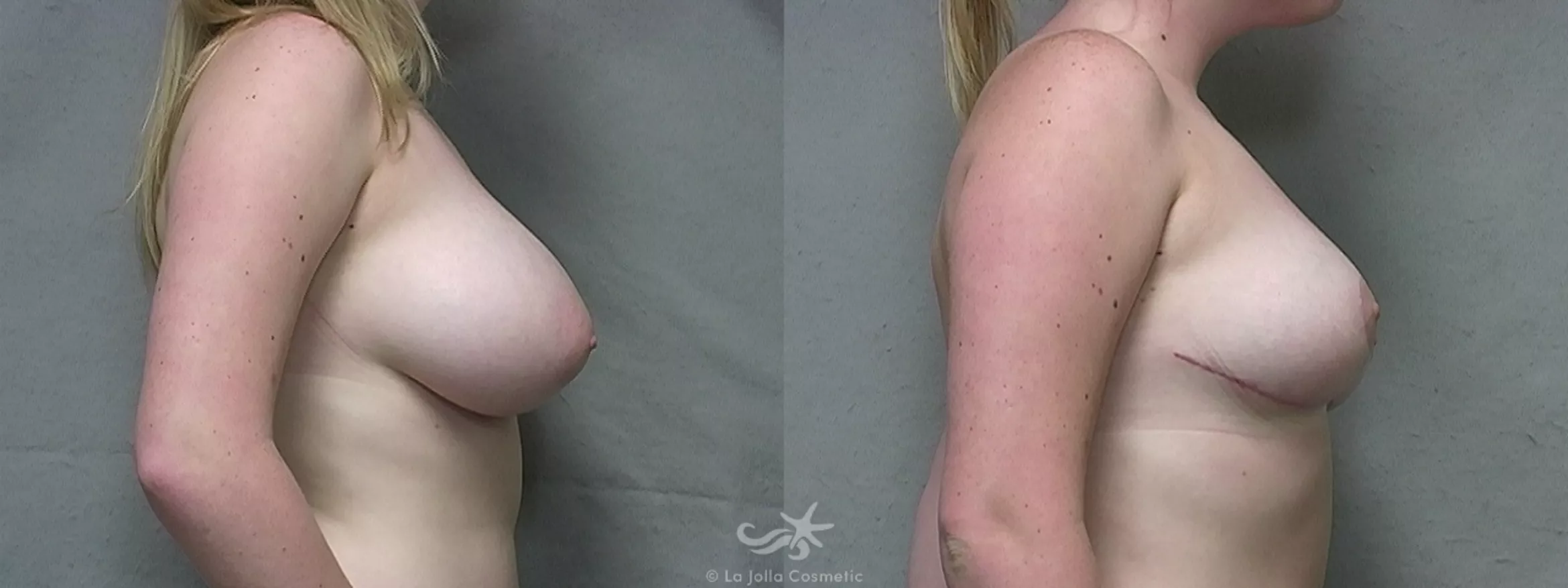 Before & After Breast Reduction Result 433 Right Side View in San Diego, CA