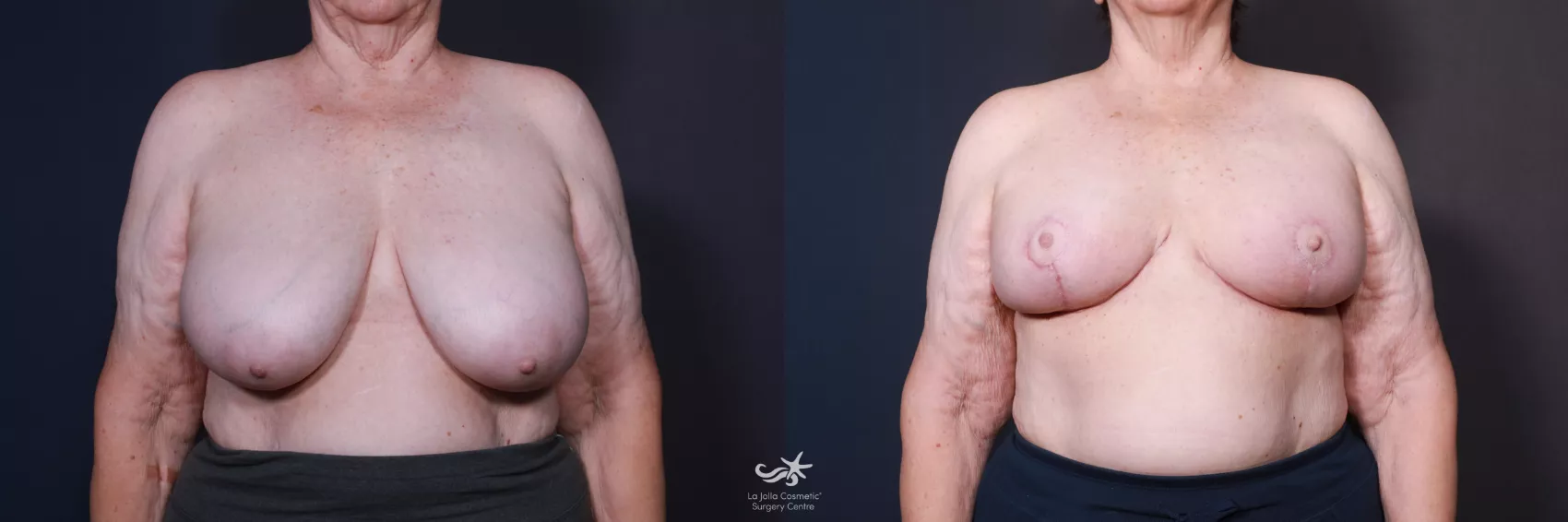 Breast Asymmetry Correction La Jolla & Coronado