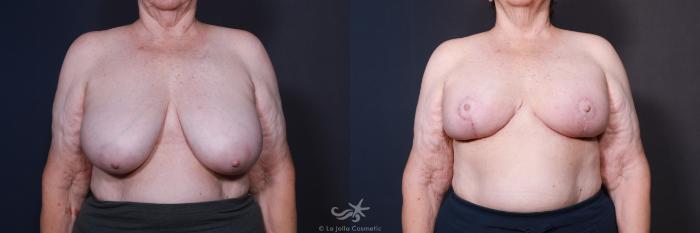 Before & After Breast Reduction Result 587 Front View in San Diego, Carlsbad, CA