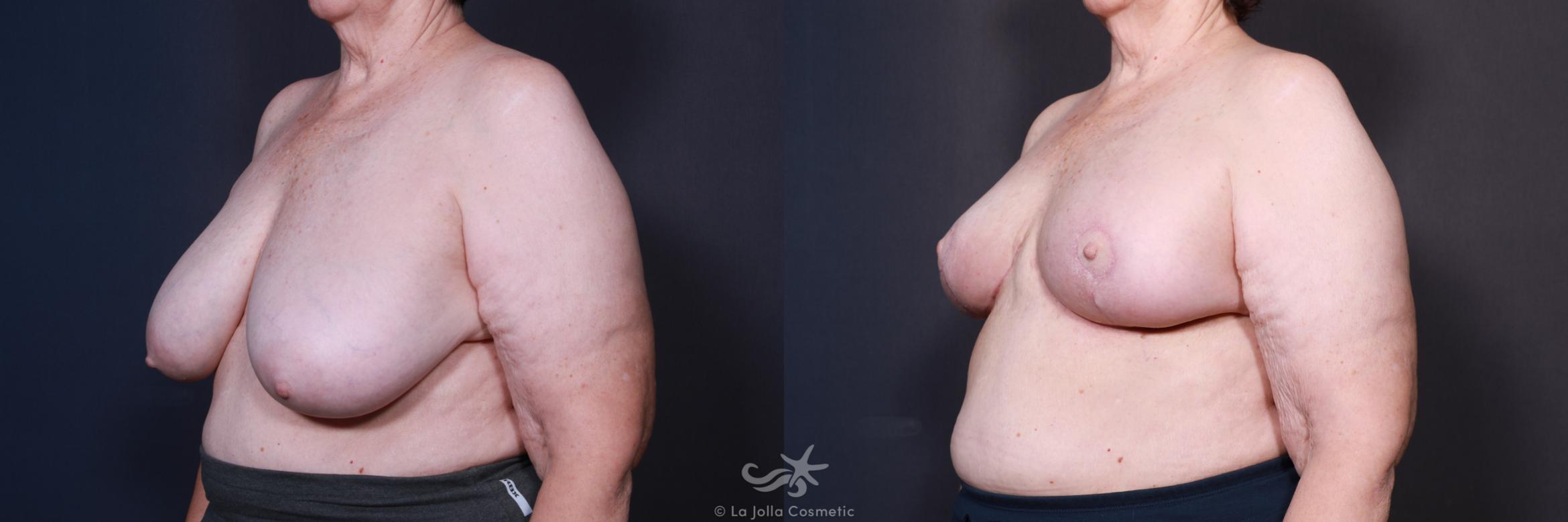 Before & After Breast Reduction Result 587 Left Oblique View in San Diego, CA