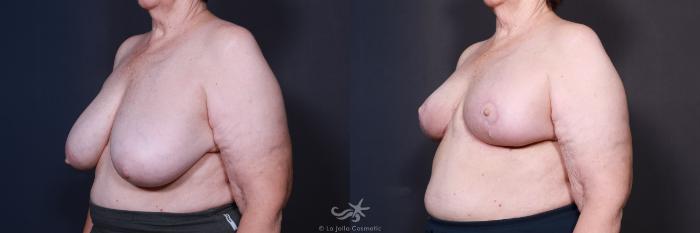 Before & After Breast Reduction Result 587 Left Oblique View in San Diego, Carlsbad, CA