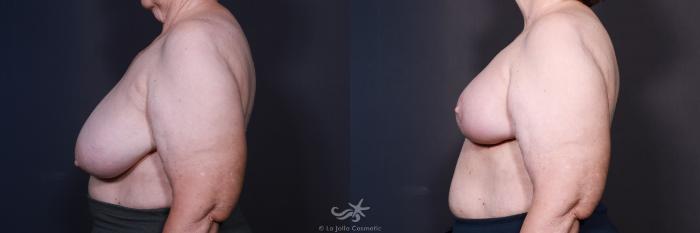 Before & After Breast Reduction Result 587 Left Side View in San Diego, Carlsbad, CA