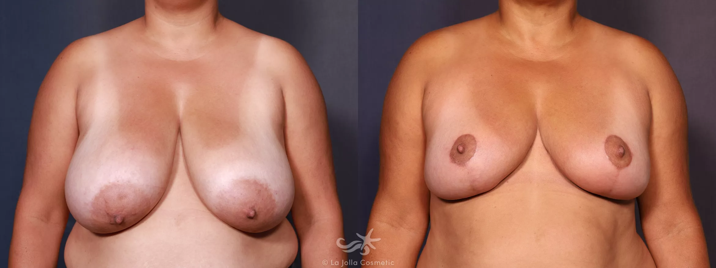 Before & After Breast Reduction Result 745 Front View in San Diego, CA