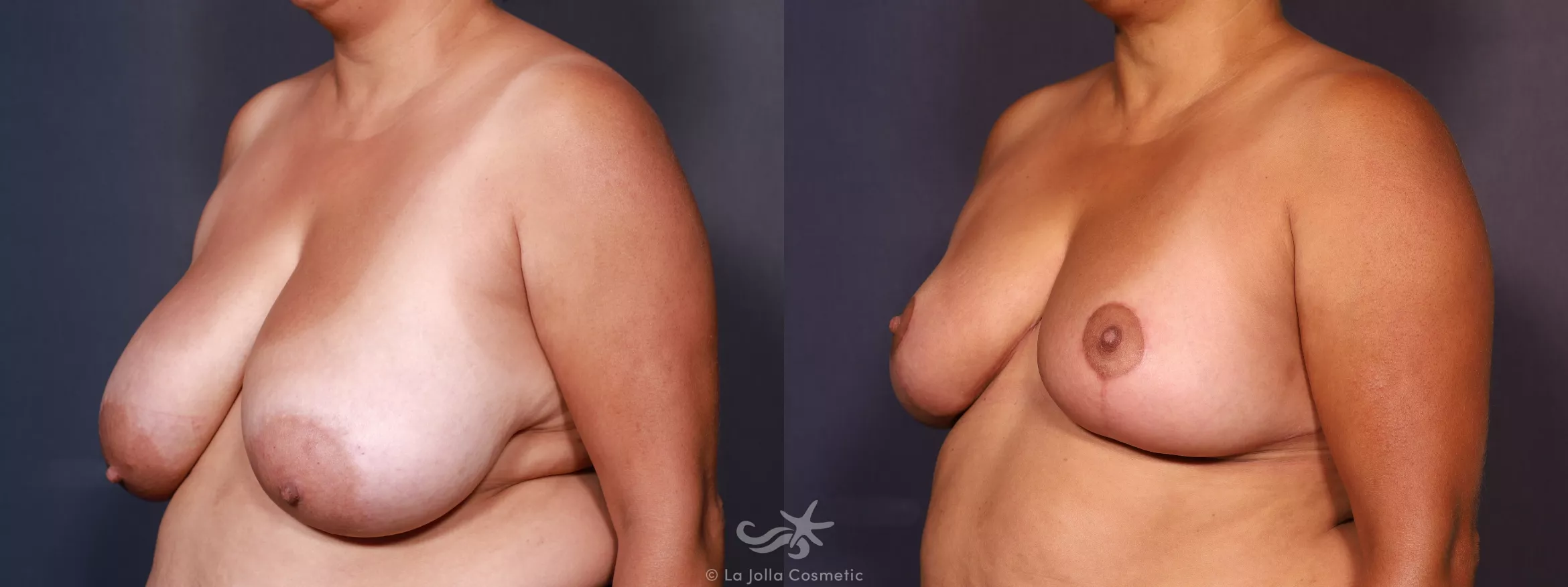 Before & After Breast Reduction Result 745 Left Oblique View in San Diego, CA