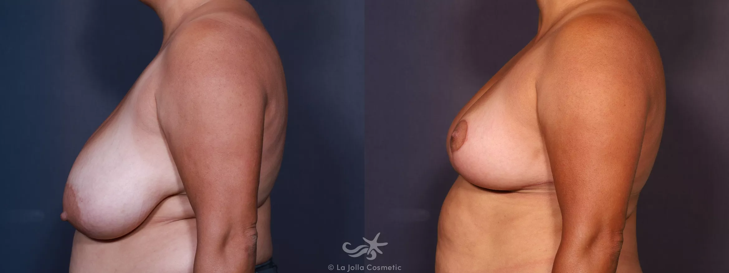 Before & After Breast Reduction Result 745 Left Side View in San Diego, CA