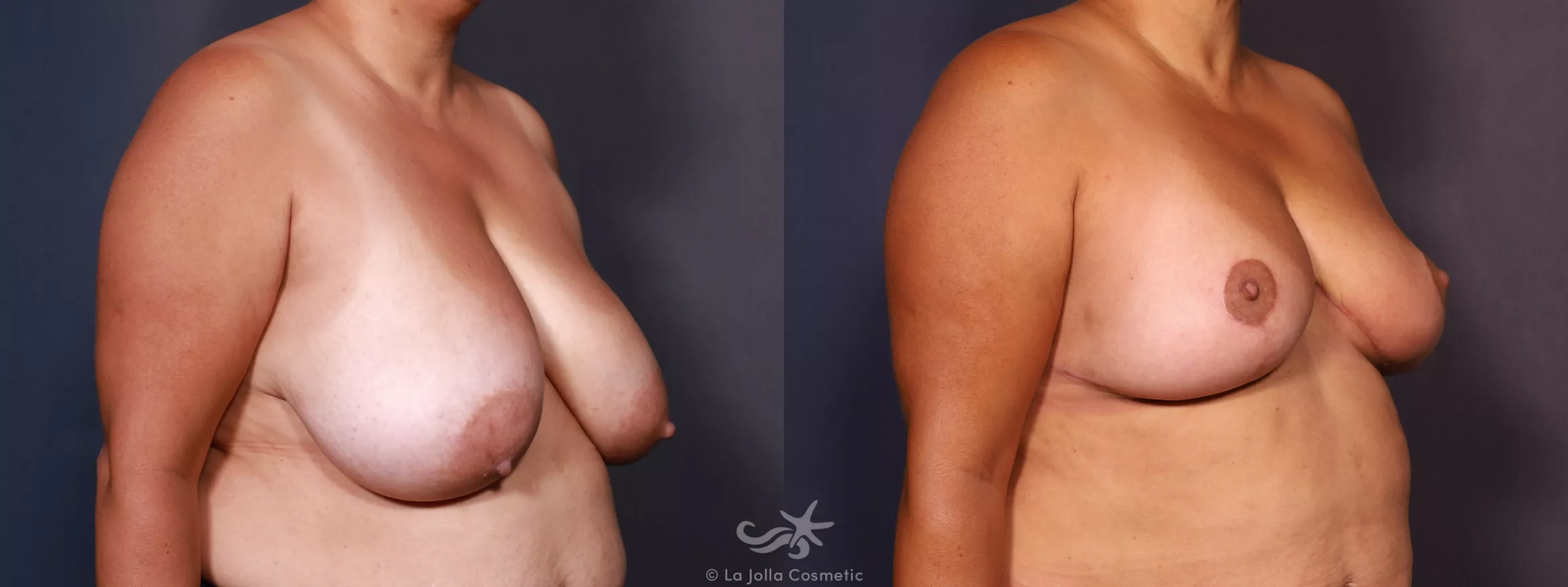 Before & After Breast Reduction Result 745 Right Oblique View in San Diego, CA