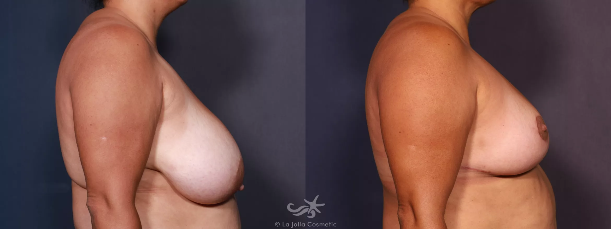 Before & After Breast Reduction Result 745 Right Side View in San Diego, CA