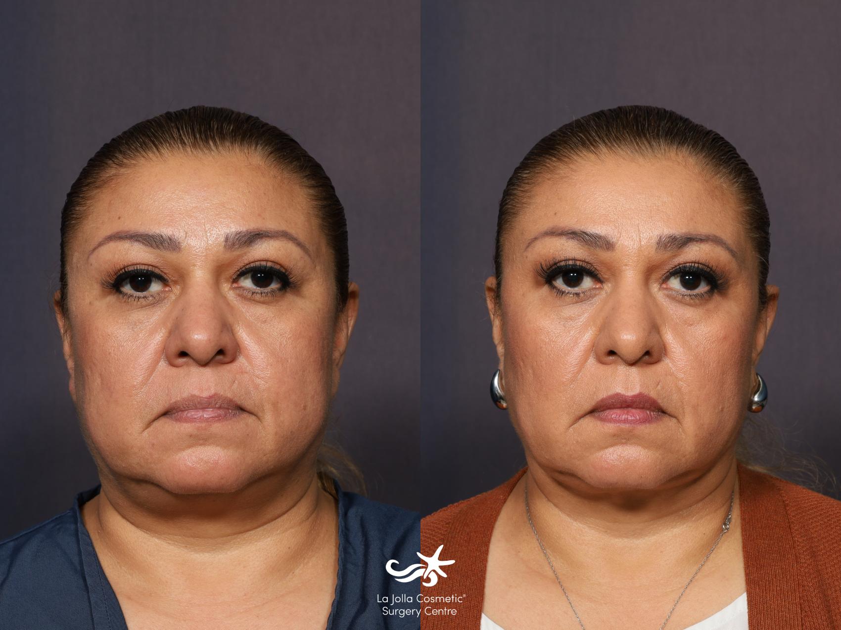 Before & After Buccal Fat Pad Removal Result 1137 Front View in San Diego, CA