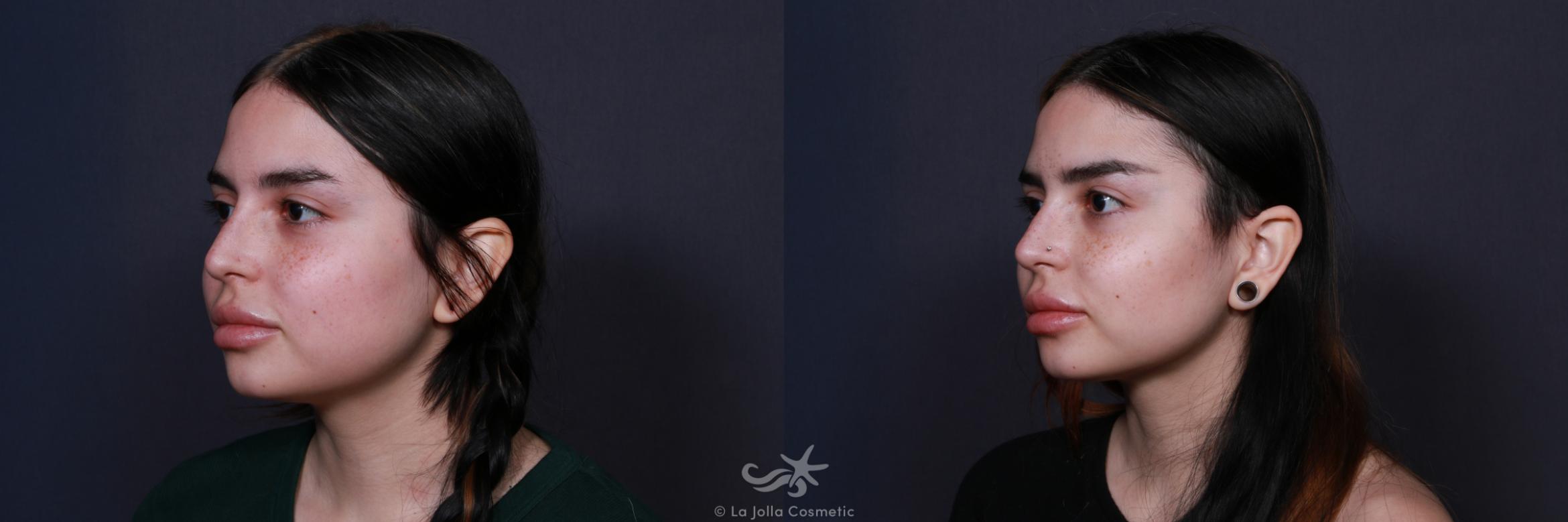 Before & After Buccal Fat Pad Removal Result 204 Left Oblique View in San Diego, CA