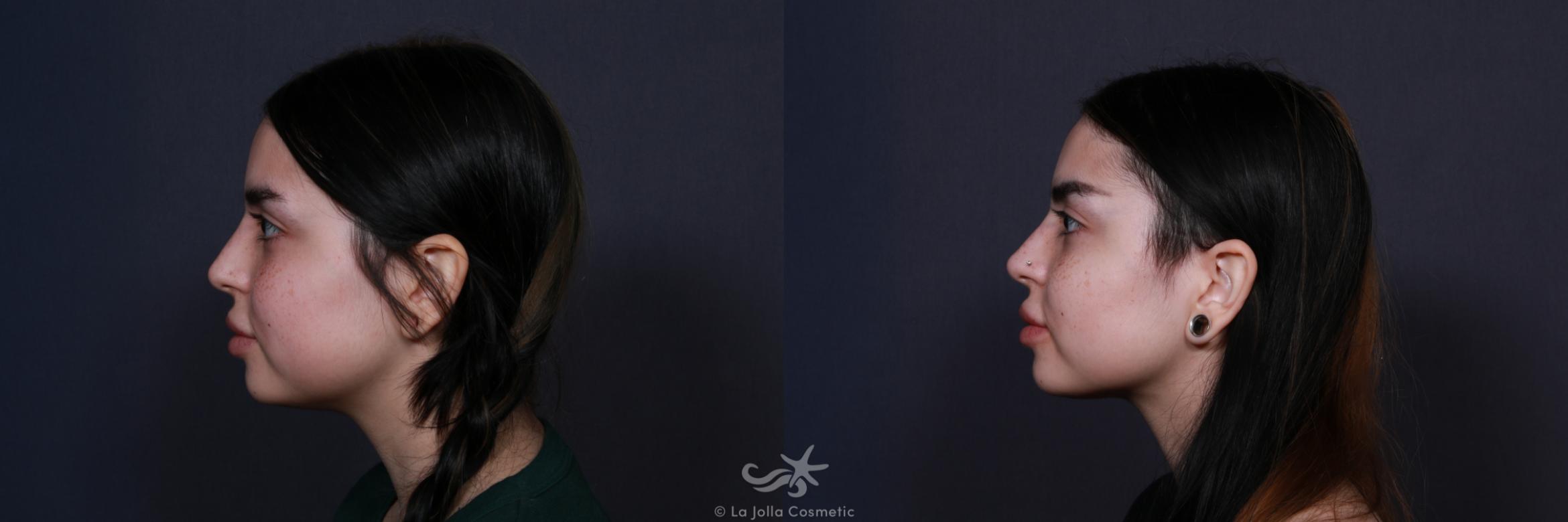 Before & After Buccal Fat Pad Removal Result 204 Left Side View in San Diego, CA
