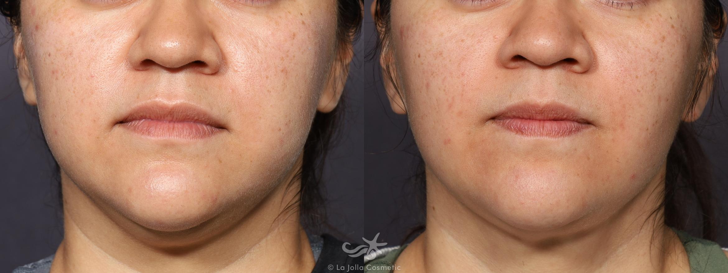 Before & After Buccal Fat Pad Removal Result 753 Front View in San Diego, Carlsbad, CA