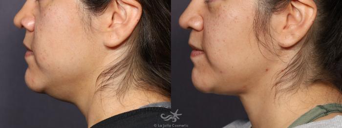 Before & After Buccal Fat Pad Removal Result 753 Left Side View in San Diego, Carlsbad, CA