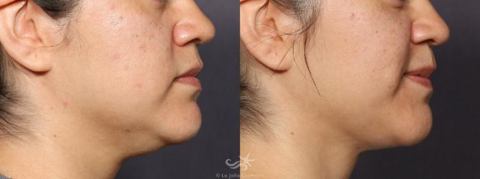Before & After Buccal Fat Pad Removal Result 753 Right Side View in San Diego, Carlsbad, CA