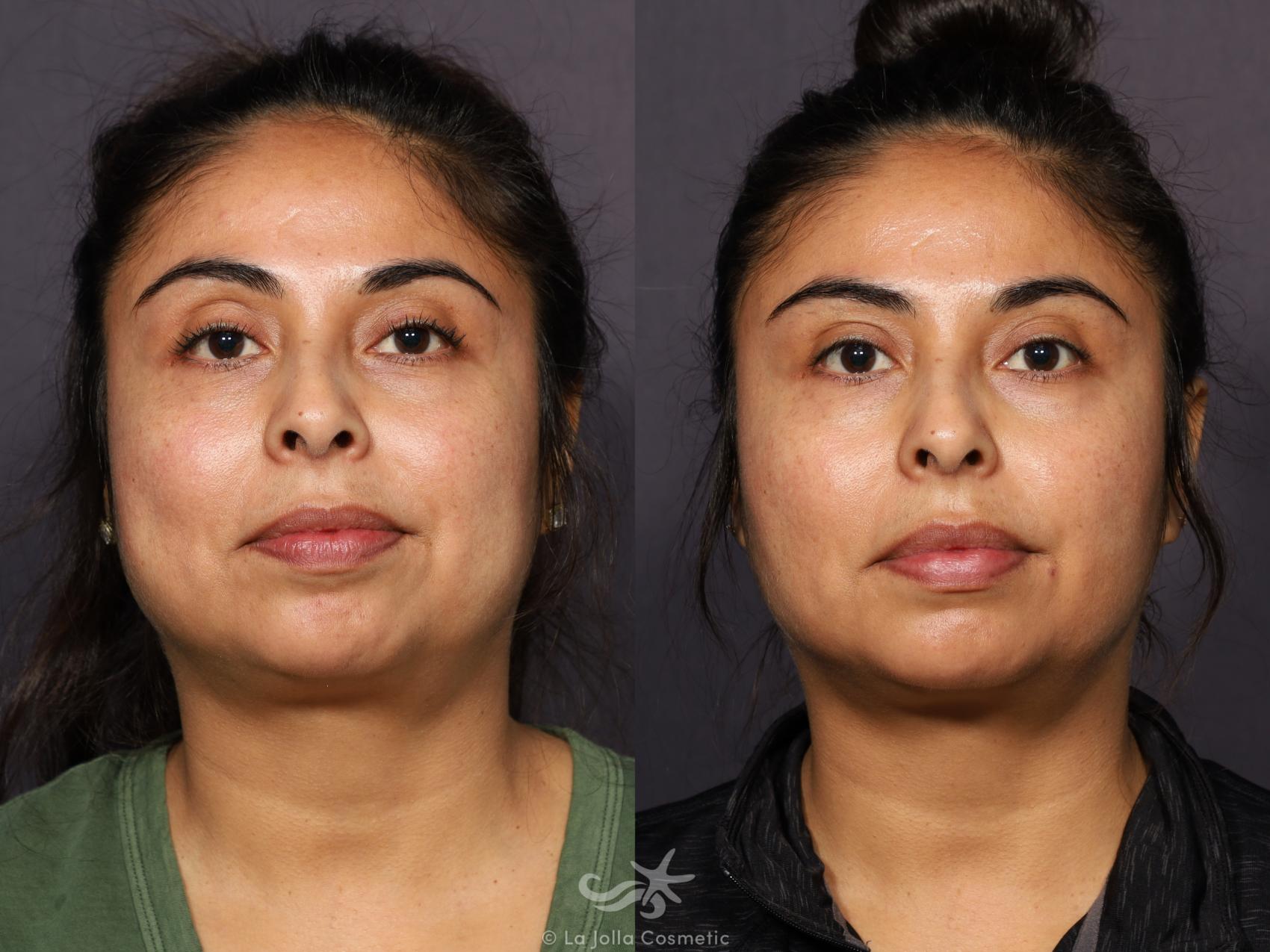 Before & After Buccal Fat Pad Removal Result 912 Front View in San Diego, Carlsbad, CA