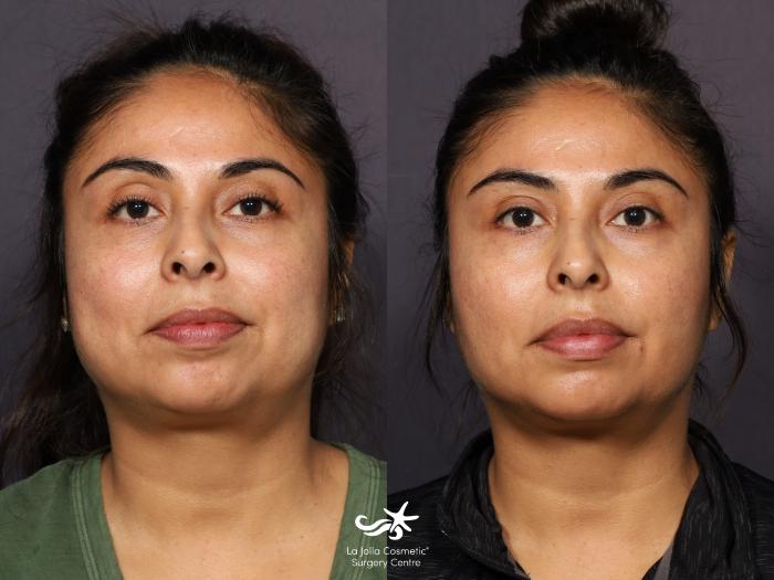 Buccal Fat Pad Removal Before and After