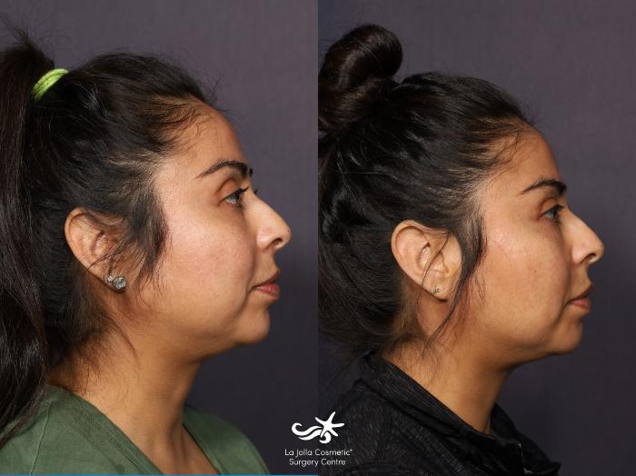 Buccal Fat Pad Removal Before and After Pictures Result 912, San Diego, CA