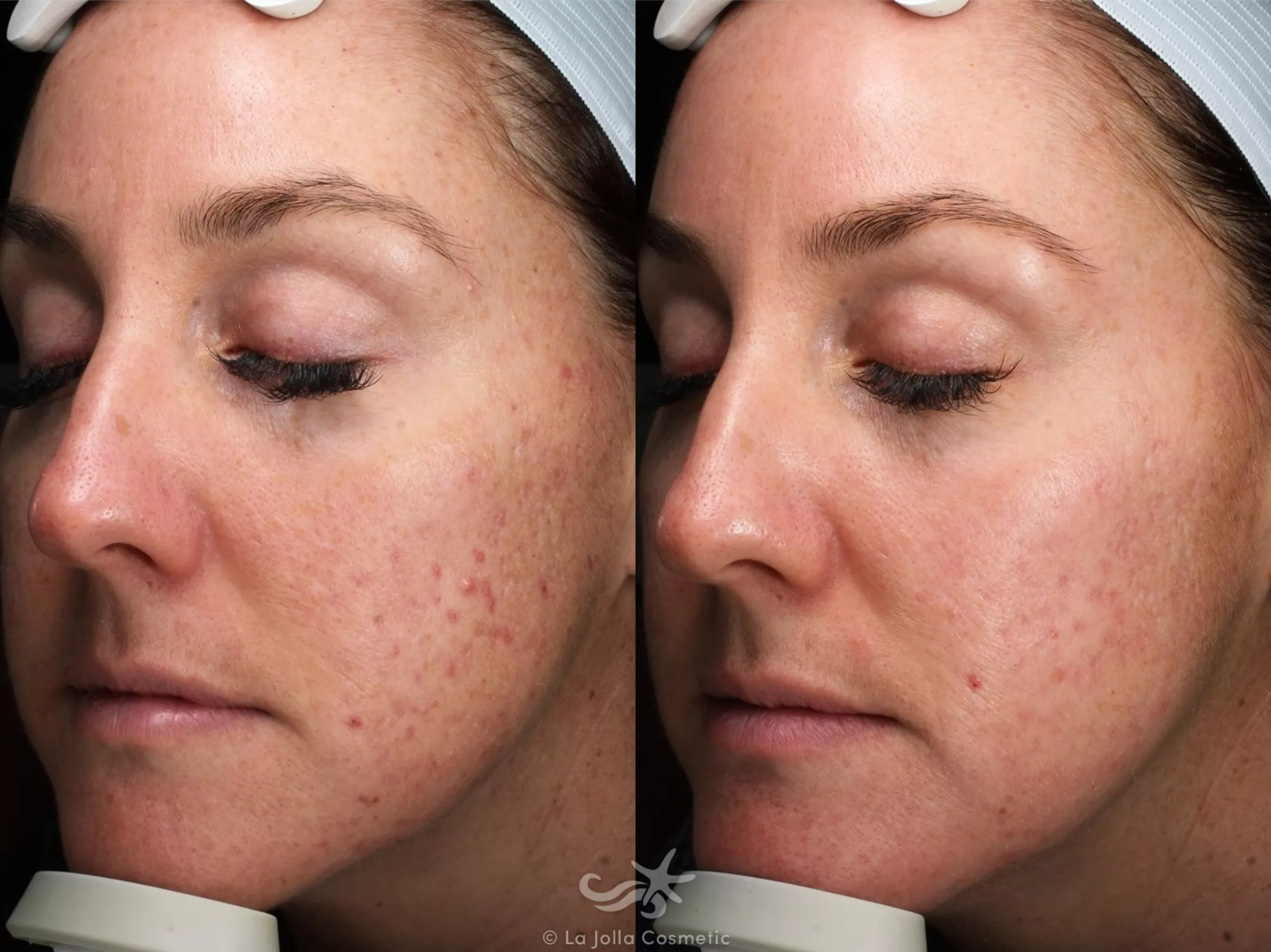 Before & After Chemical Peels Result 734 Left Oblique View in San Diego, CA