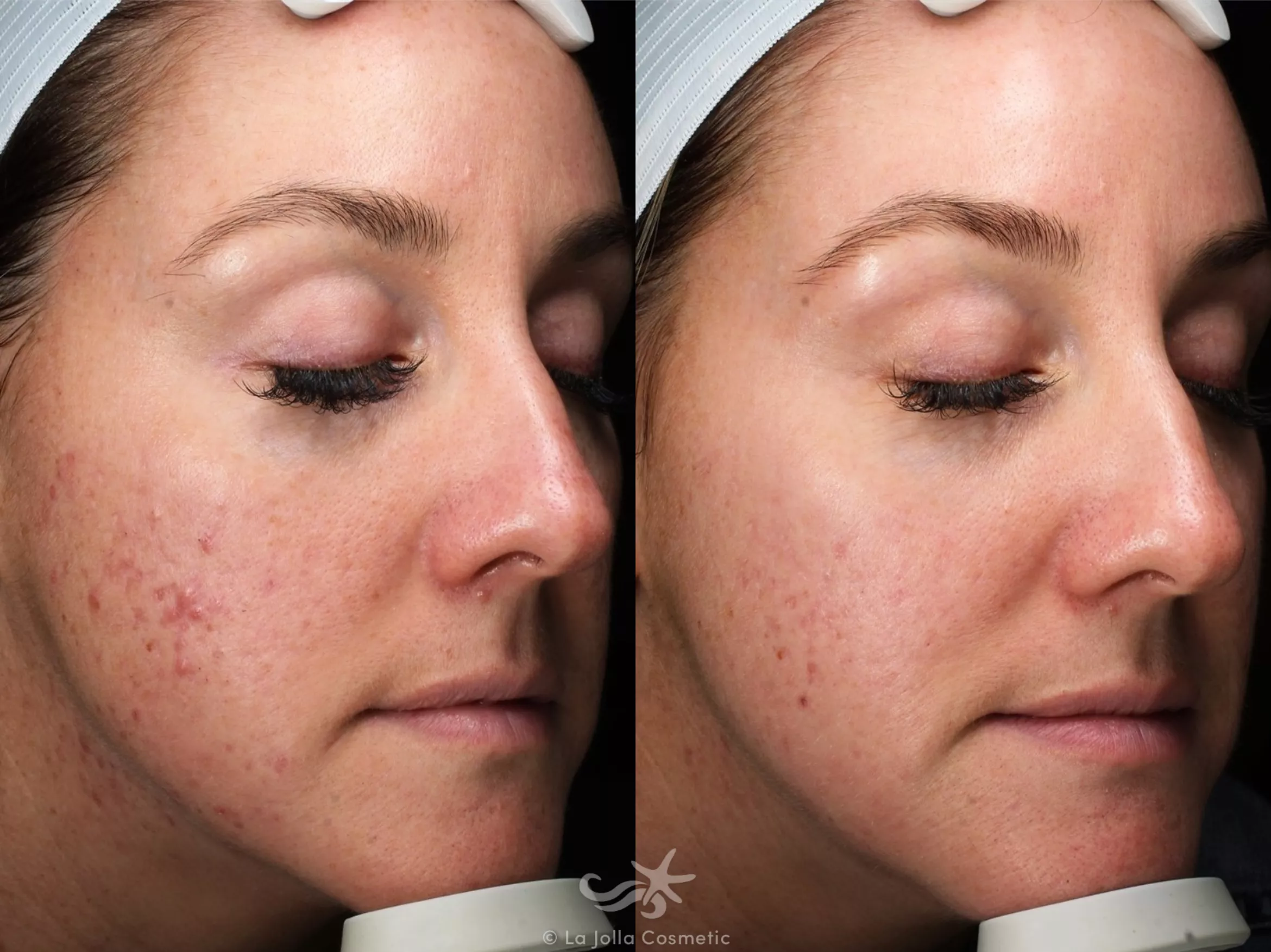 Before & After Chemical Peels Result 734 Right Oblique View in San Diego, CA