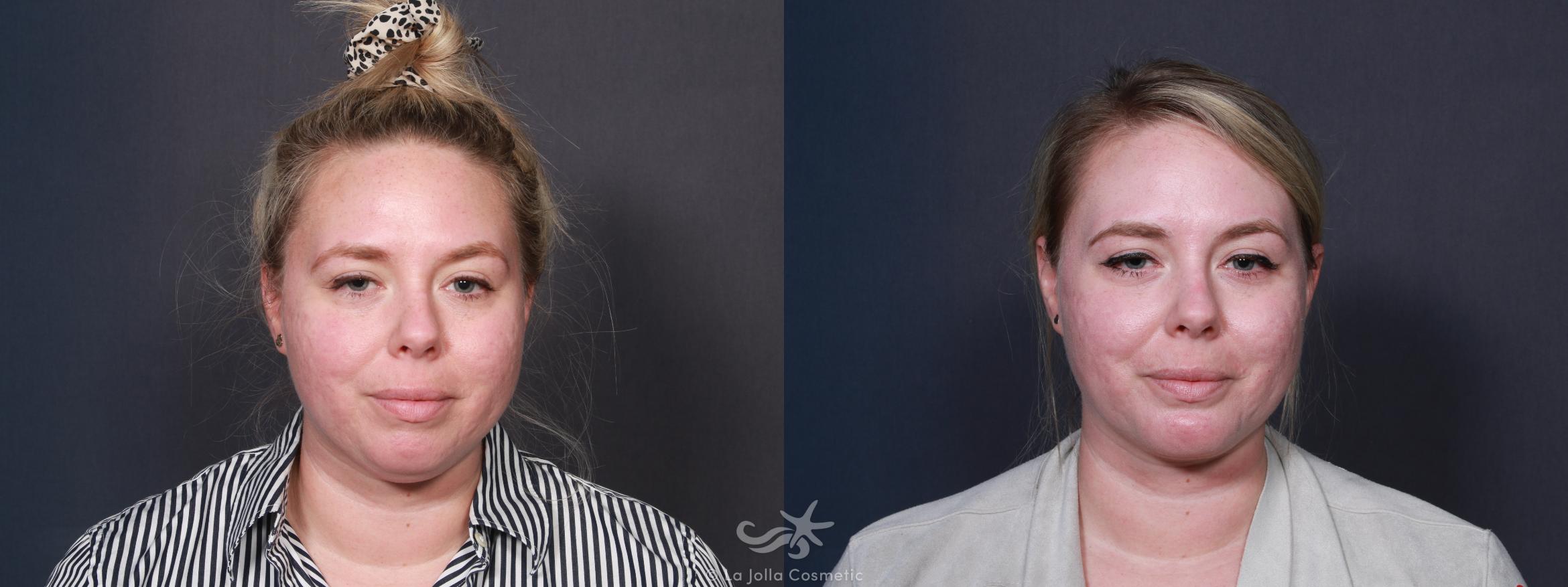 Before & After Chin Enlargement Result 107 Front View in San Diego, CA