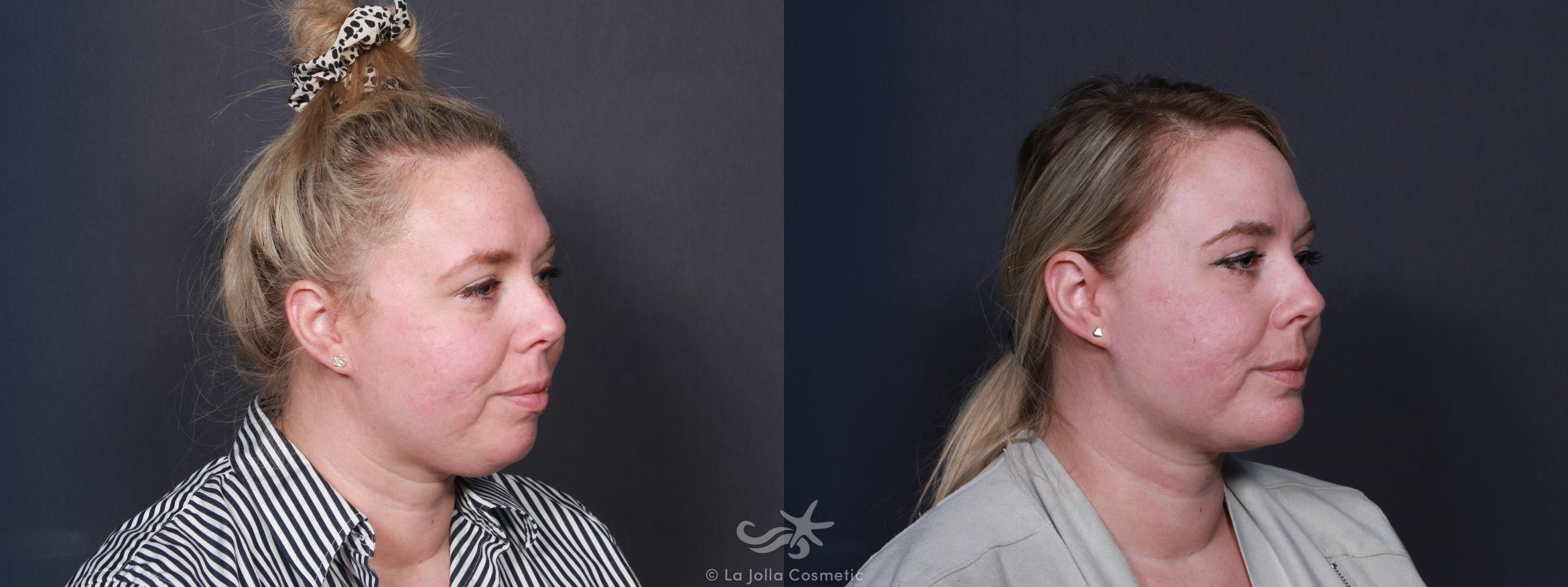 Before & After Chin Enlargement Result 107 Right Oblique View in San Diego, CA