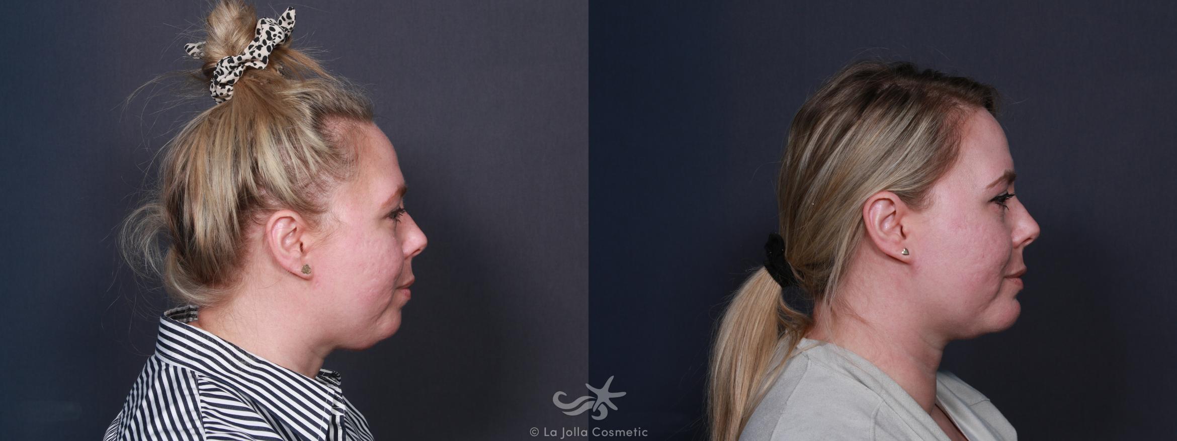 Before & After Chin Enlargement Result 107 Right Side View in San Diego, CA