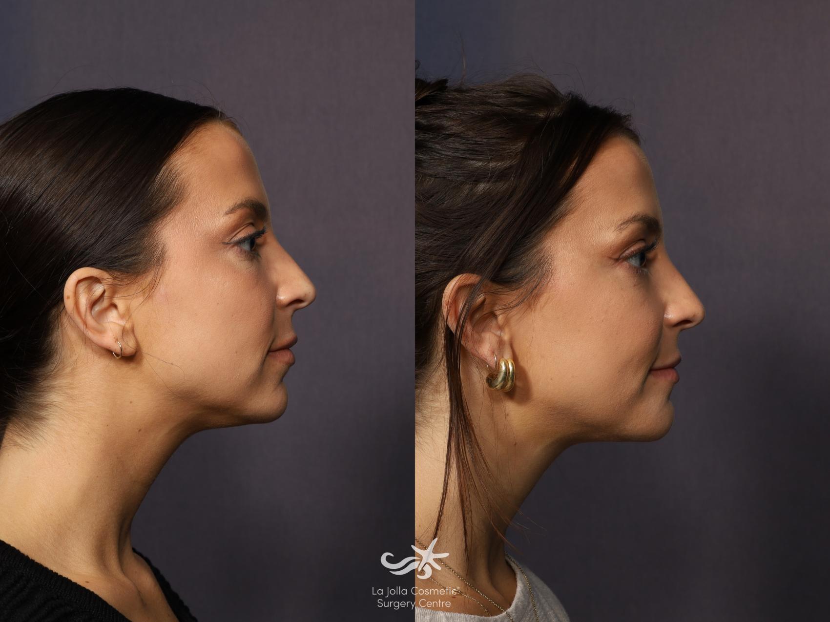 Before & After Chin Enlargement Result 1116 Right Side View in San Diego, CA