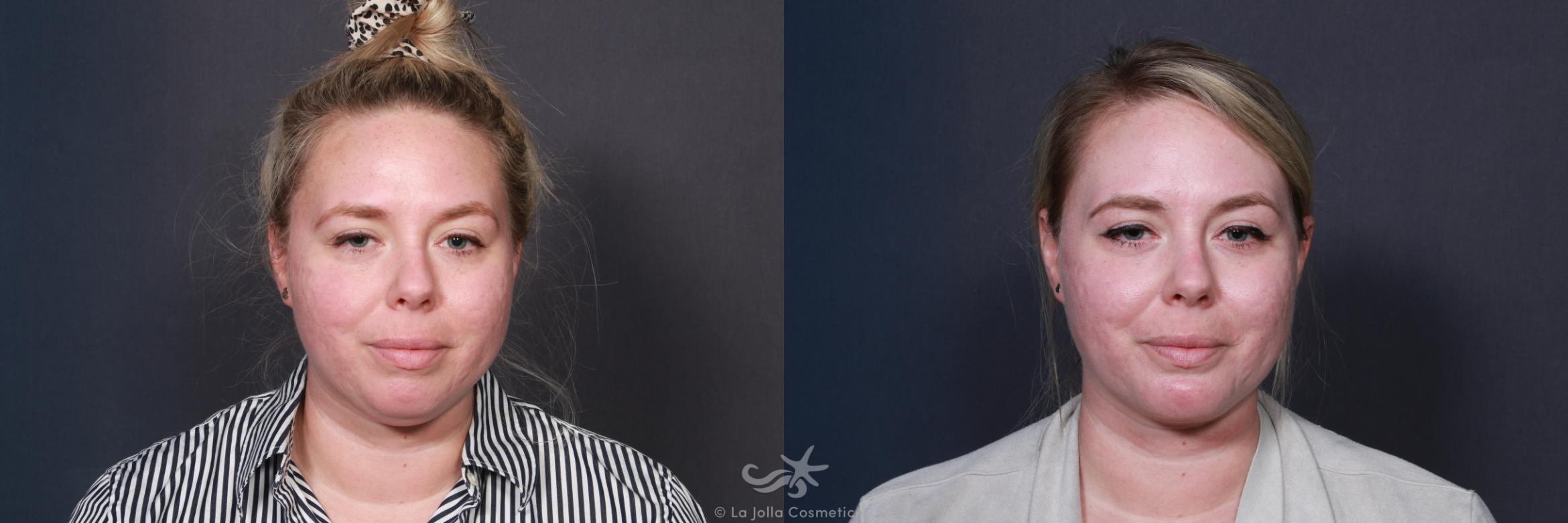 Before & After Neck Liposuction Result 19 Front View in San Diego, CA