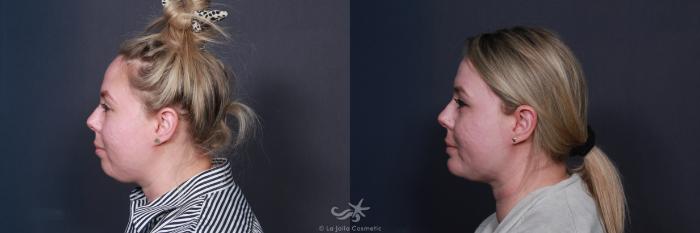 Before & After Chin Enlargement Result 19 Left Side View in San Diego, Carlsbad, CA