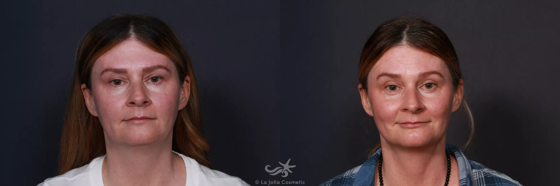 Before & After Chin Enlargement Result 211 Front View in San Diego, CA