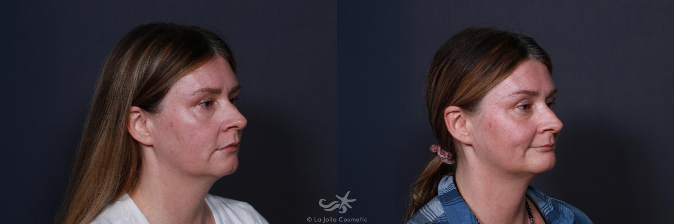 Before & After Chin Enlargement Result 211 Right Oblique View in San Diego, CA