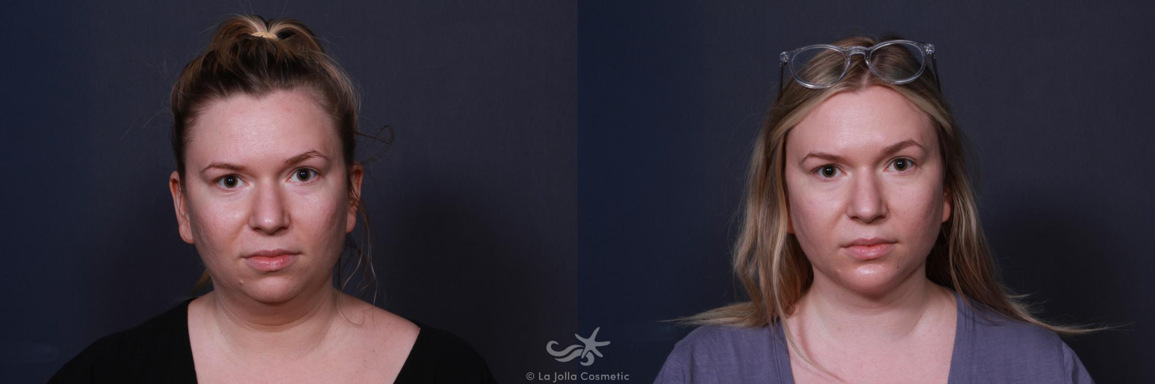 Before & After Chin Enlargement Result 221 Front View in San Diego, CA