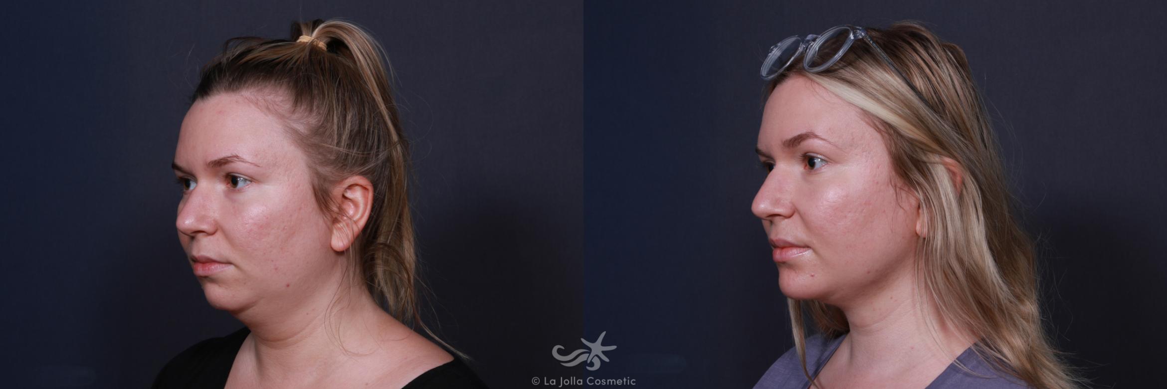 Before & After Chin Enlargement Result 221 Left Oblique View in San Diego, CA